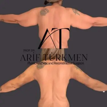 Брахіопластика - підтяжка шкіри рук в Туреччині
