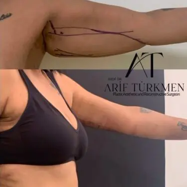 Брахіопластика - підтяжка шкіри рук в Туреччині