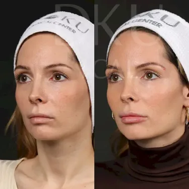 Увеличение губ