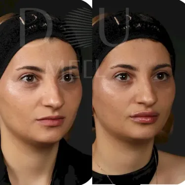 Увеличение губ