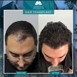 найкраща клініка з трансплантації волосся в Туреччині