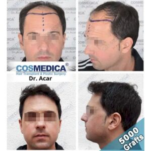 Hair transplantation in Turkey, Cosmedica Clinic