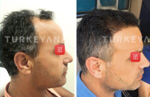 top hair transplant clinics in turkey