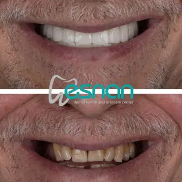 Лечение зубов в Турции