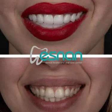 Лечение зубов в Турции