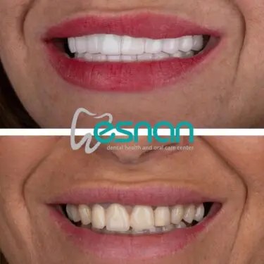 Лечение зубов в Турции