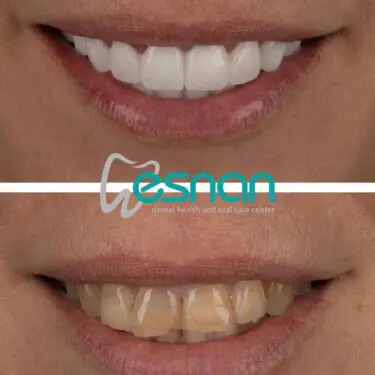 Лечение зубов в Турции