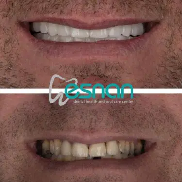 Лечение зубов в Турции