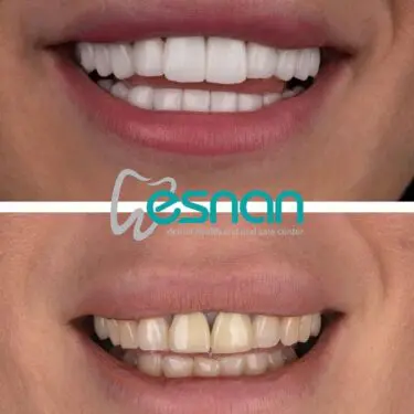 Лечение зубов в Турции