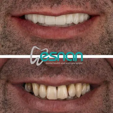 Лечение зубов в Турции