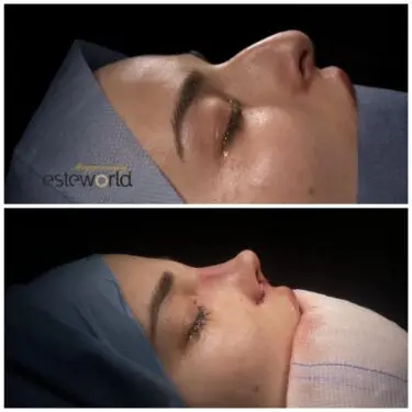 Ультразвуковая ринопластика в Турции