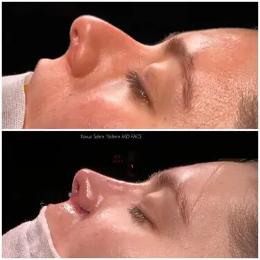 Ультразвуковая ринопластика в Турции