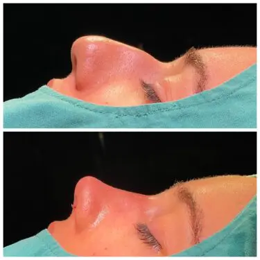 Ультразвуковая ринопластика в Турции