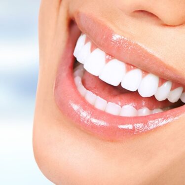 Teeth whitening in Turkey