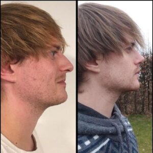 photo before after rhinoplasty