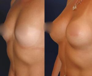 Teardrop breast implants before and after