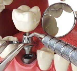 Виды зубных имплантов: какое решение выбрать?