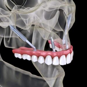 Различные типы зубных имплантов