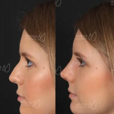 Rhinoplastik