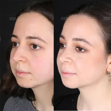 Rhinoplastik