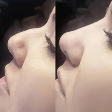 Rhinoplastik