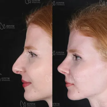 Rhinoplastik