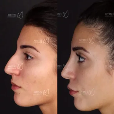 Rhinoplastik