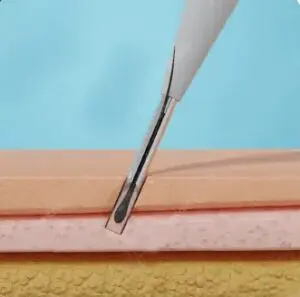 DHI hair transplant in Turkey