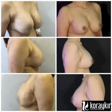 Мамопластика