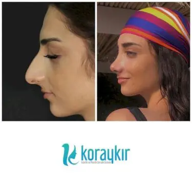 Ринопластика