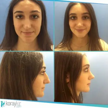 Ринопластика