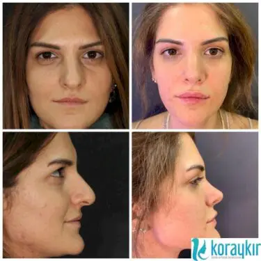 Ринопластика