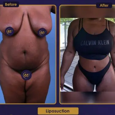 Liposuction
