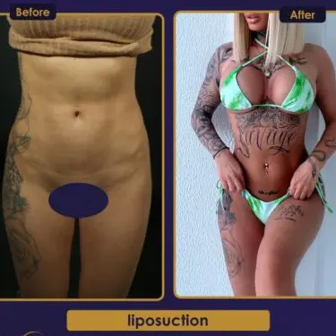 Liposuction