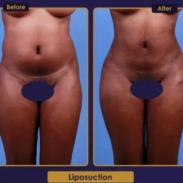 Liposuction
