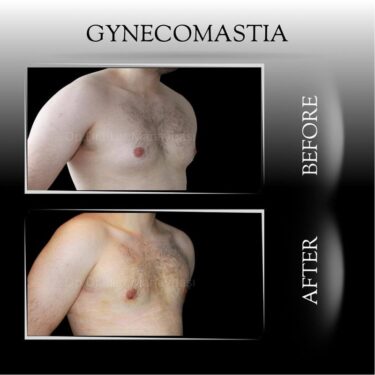 Гинекомастия
