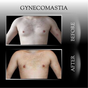 Гинекомастия