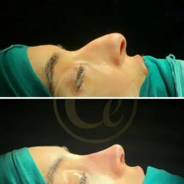 Rhinoplasty
