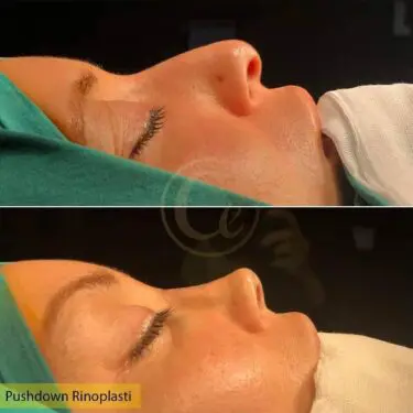 Rhinoplasty