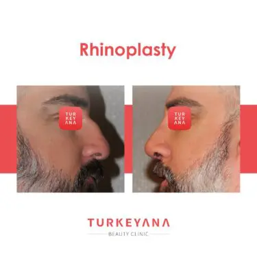 Ринопластика