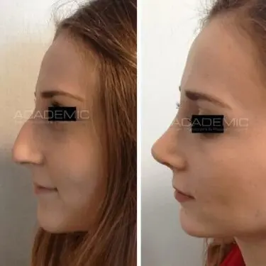 Rhinoplastik