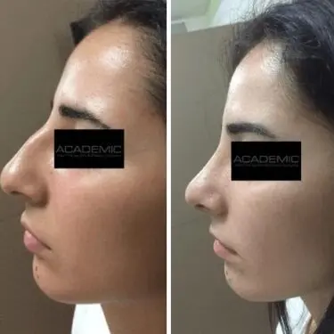 Rhinoplastik