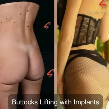 Бразильская подтяжка ягодиц в Турции