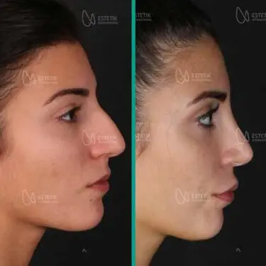 Ультразвуковая ринопластика в Турции