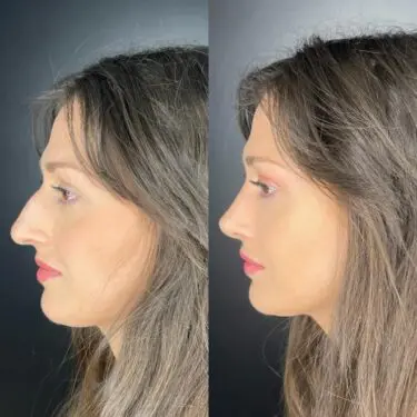 Ультразвуковая ринопластика в Турции