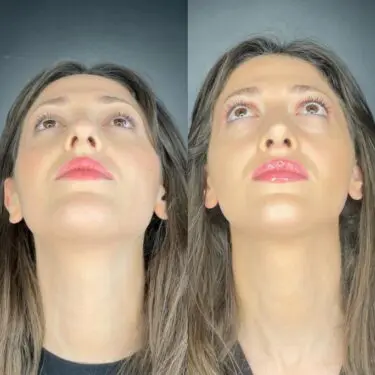 Ультразвуковая ринопластика в Турции