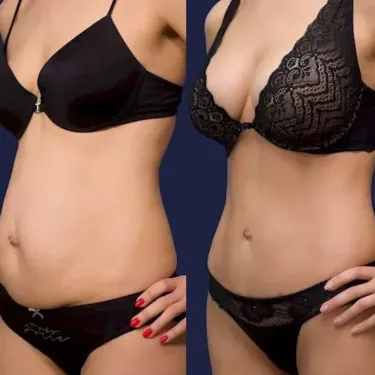 Abdominoplastie