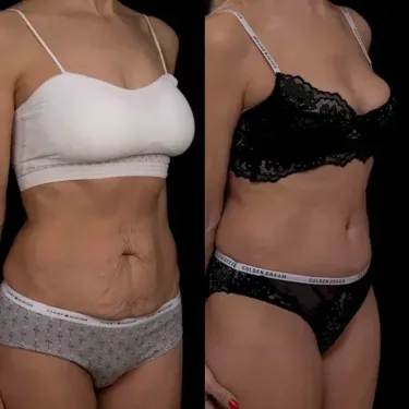 Abdominoplastie