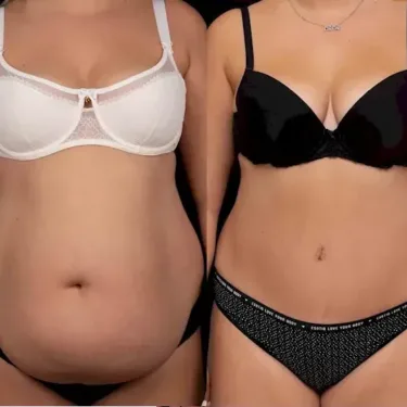 Abdominoplastie