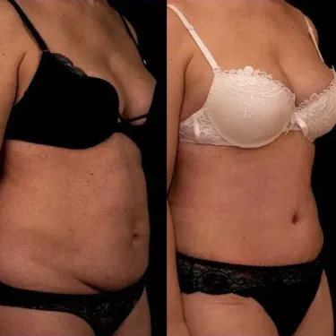 Abdominoplastie
